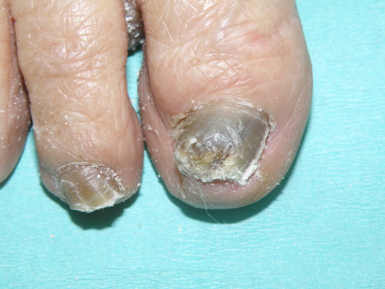 意外にすぐ治る爪甲鉤弯症？！